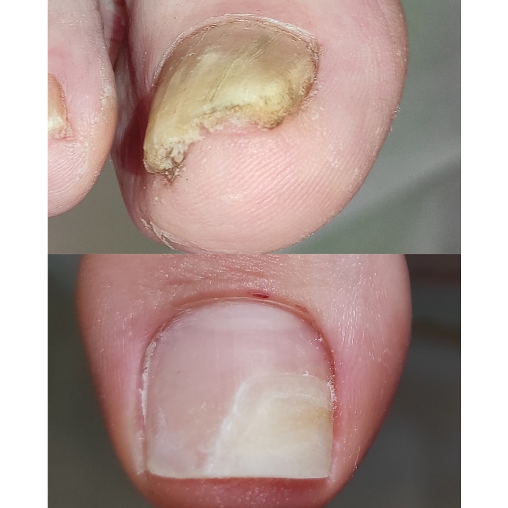 Обработка онихолизиса, онихогрифоза или микоза на ногах 1 ноготь
