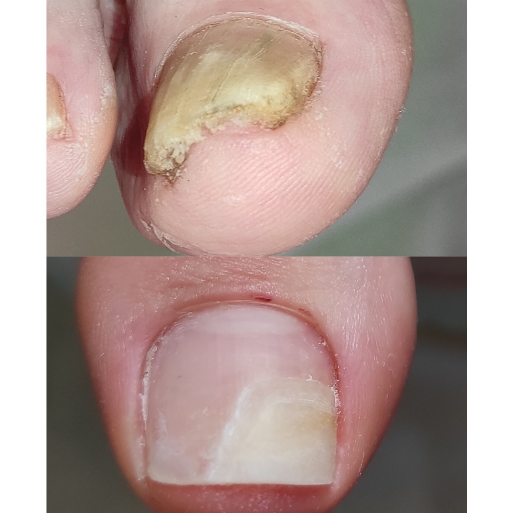 Обработка онихолизиса, онихогрифоза или микоза на ногах 4-6 ногтей