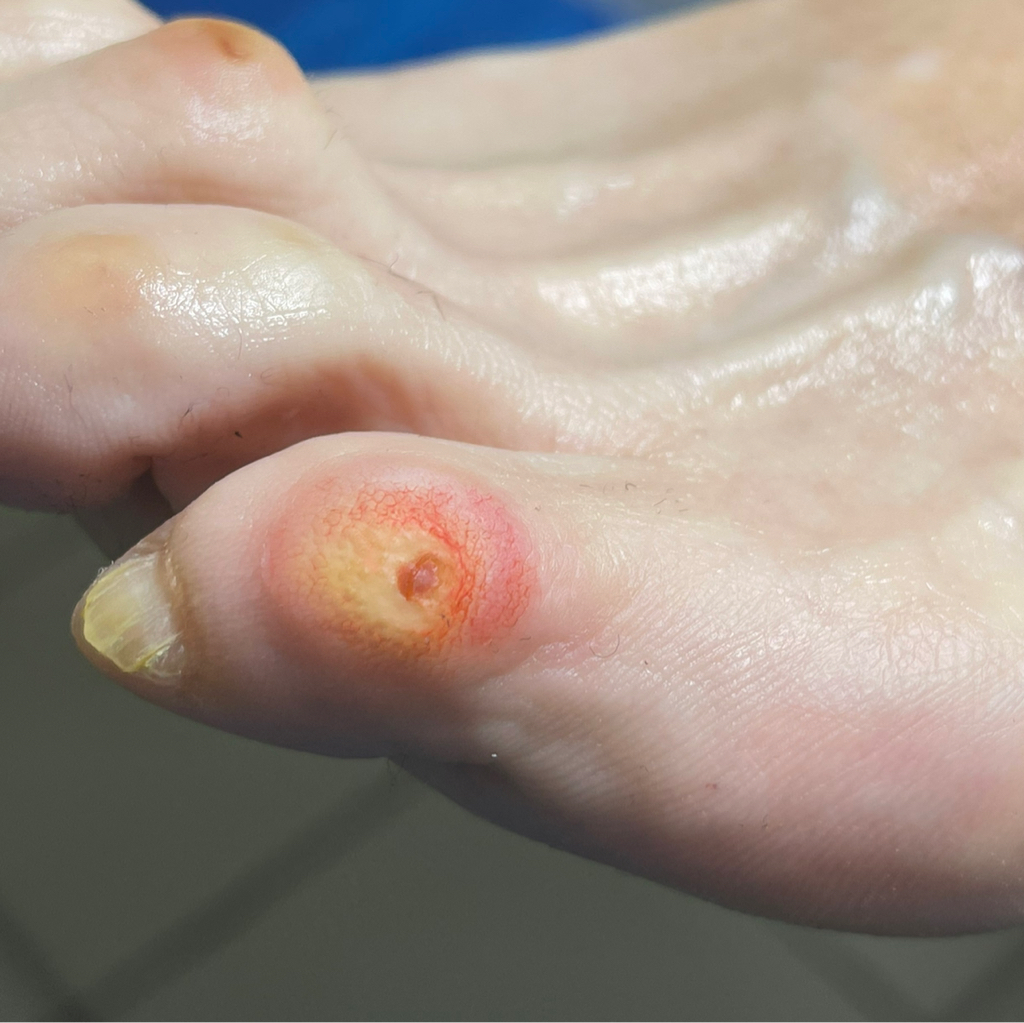 обработка стержневой мозоли