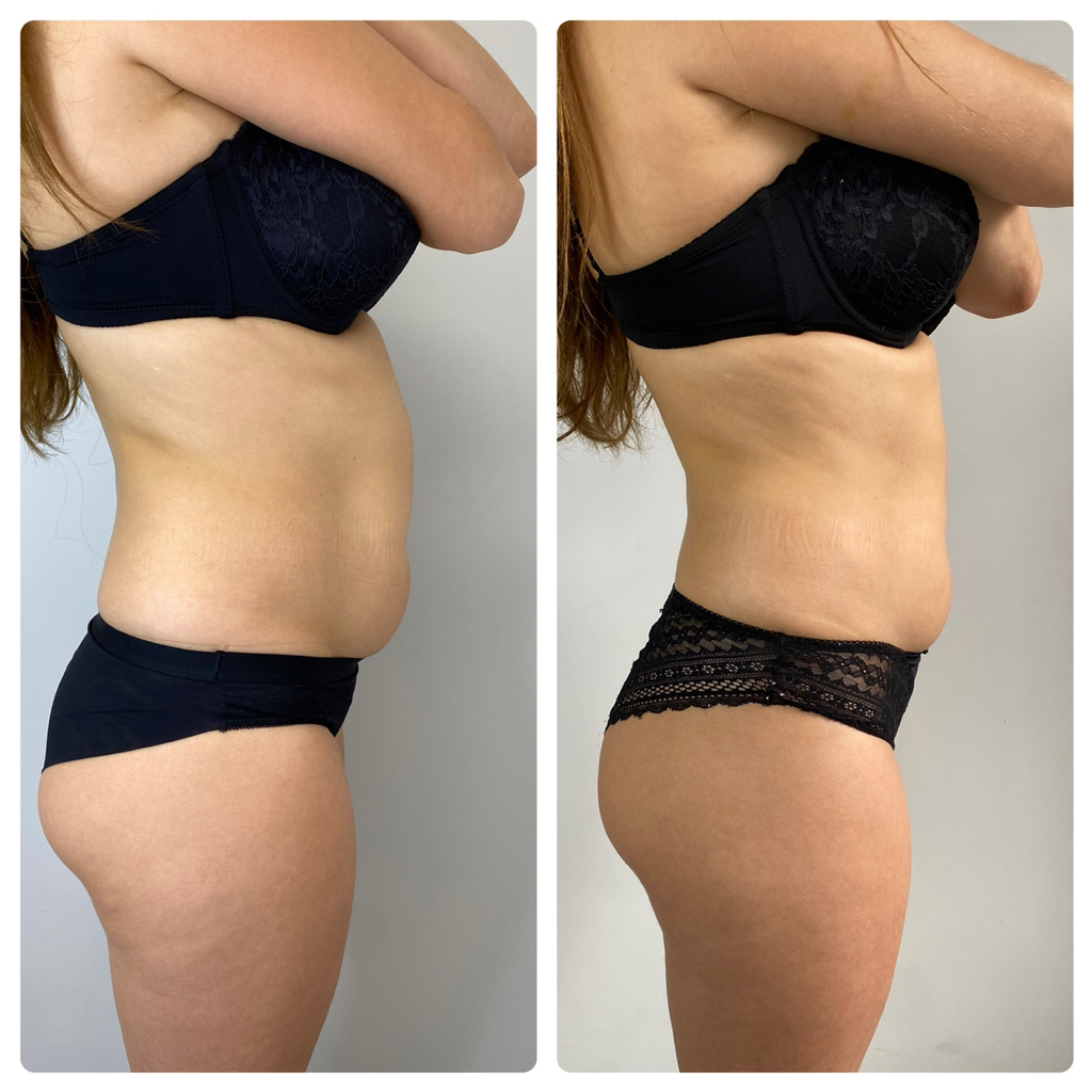 Похудение (липолитики)