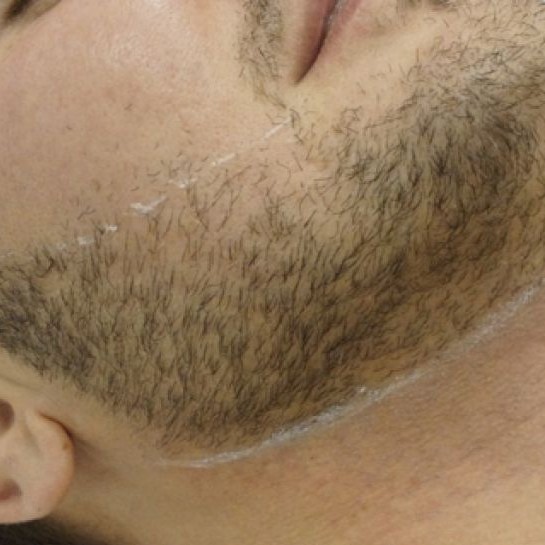 лицо одна зона. депиляция мужская