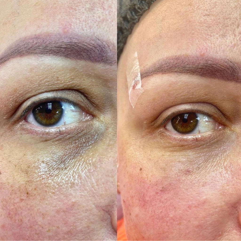 Комплекс «Свежий взгляд» (работа с носослёзной бороздой и кожей век)