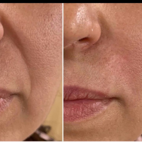 Заполнение морщин филлером