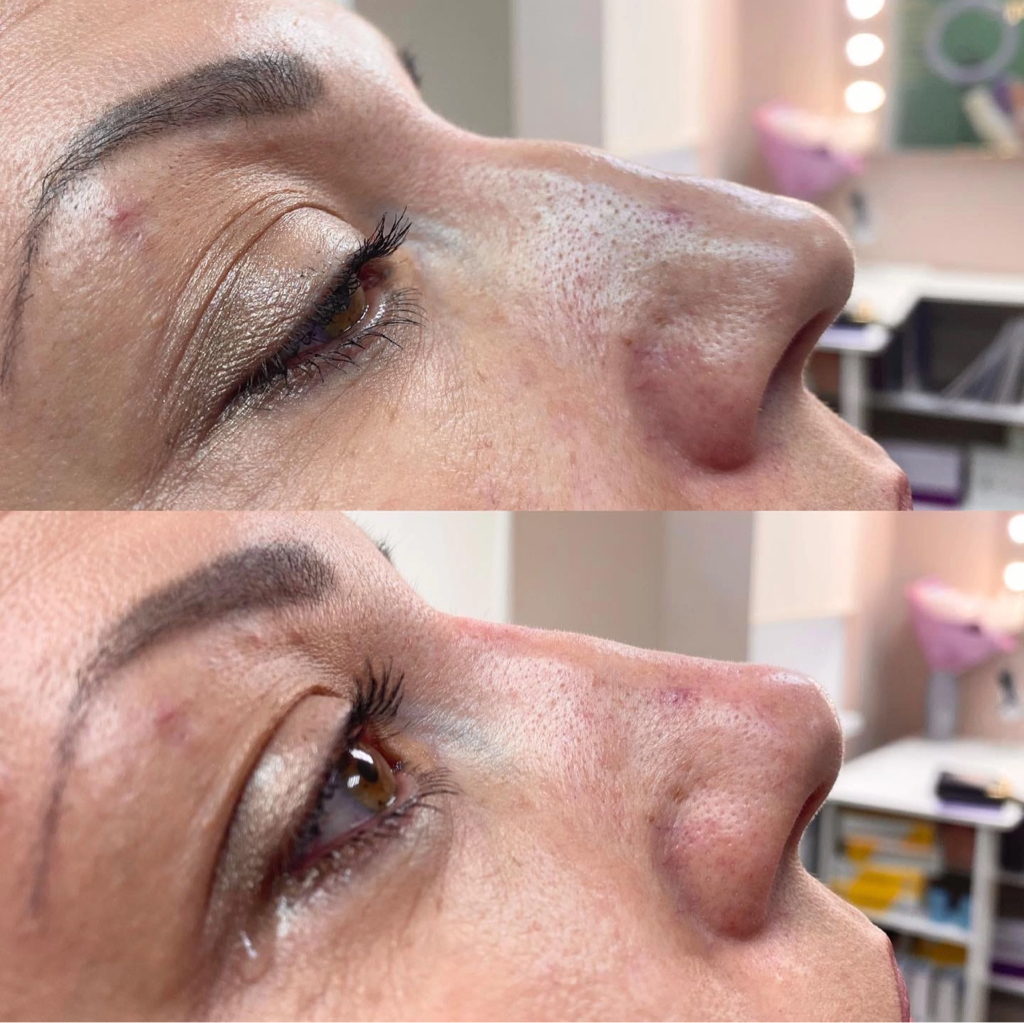 Контуринг носа