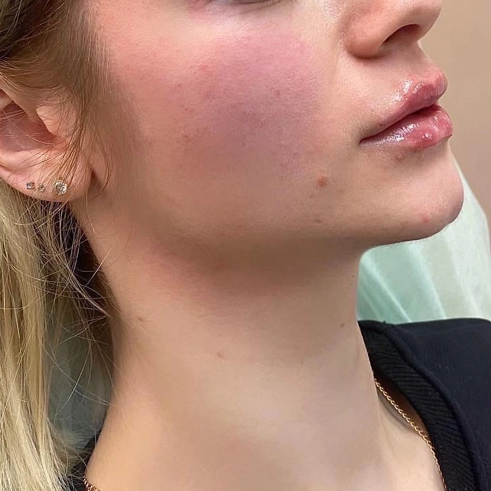 Контуринг «Овал лица»