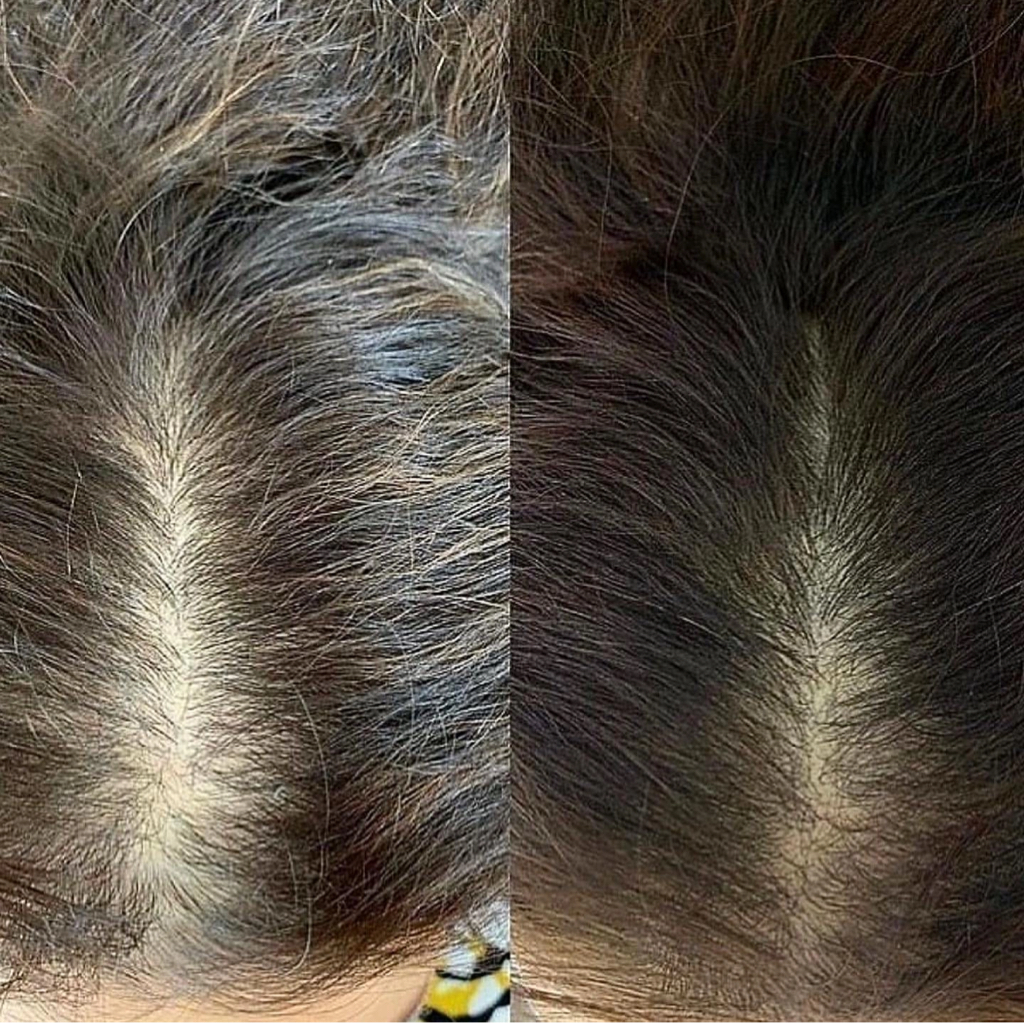 Мезотерапия кожи головы (рост/густота волос)