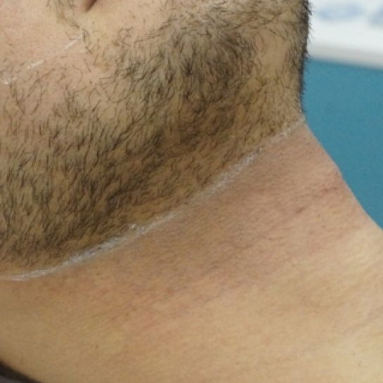 Комплекс бикини, подмышки. мужская депиляция