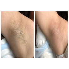 Депиляция воском подмышечных впадин