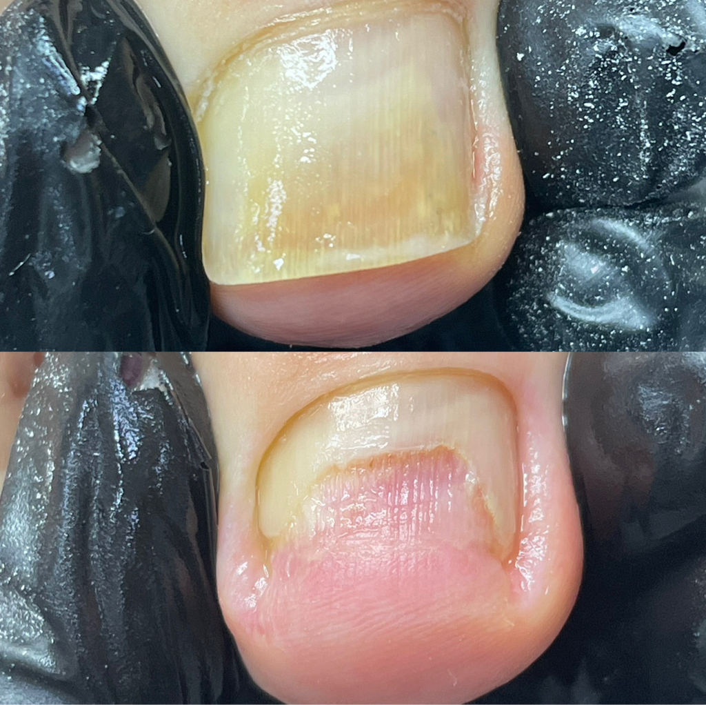 зачистка ногтевой пластины