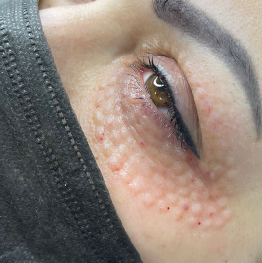 Биоревитализация вокруг глаз  Препарат премиум класса