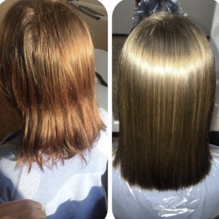 Биксипластия средняя длина .Акция!!!