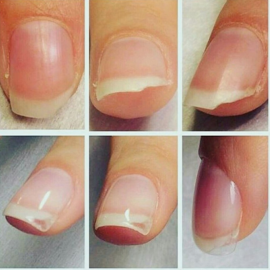 Ремонт одного ногтя
