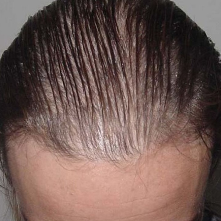 Фракционная мезотерапия волосистой части головы