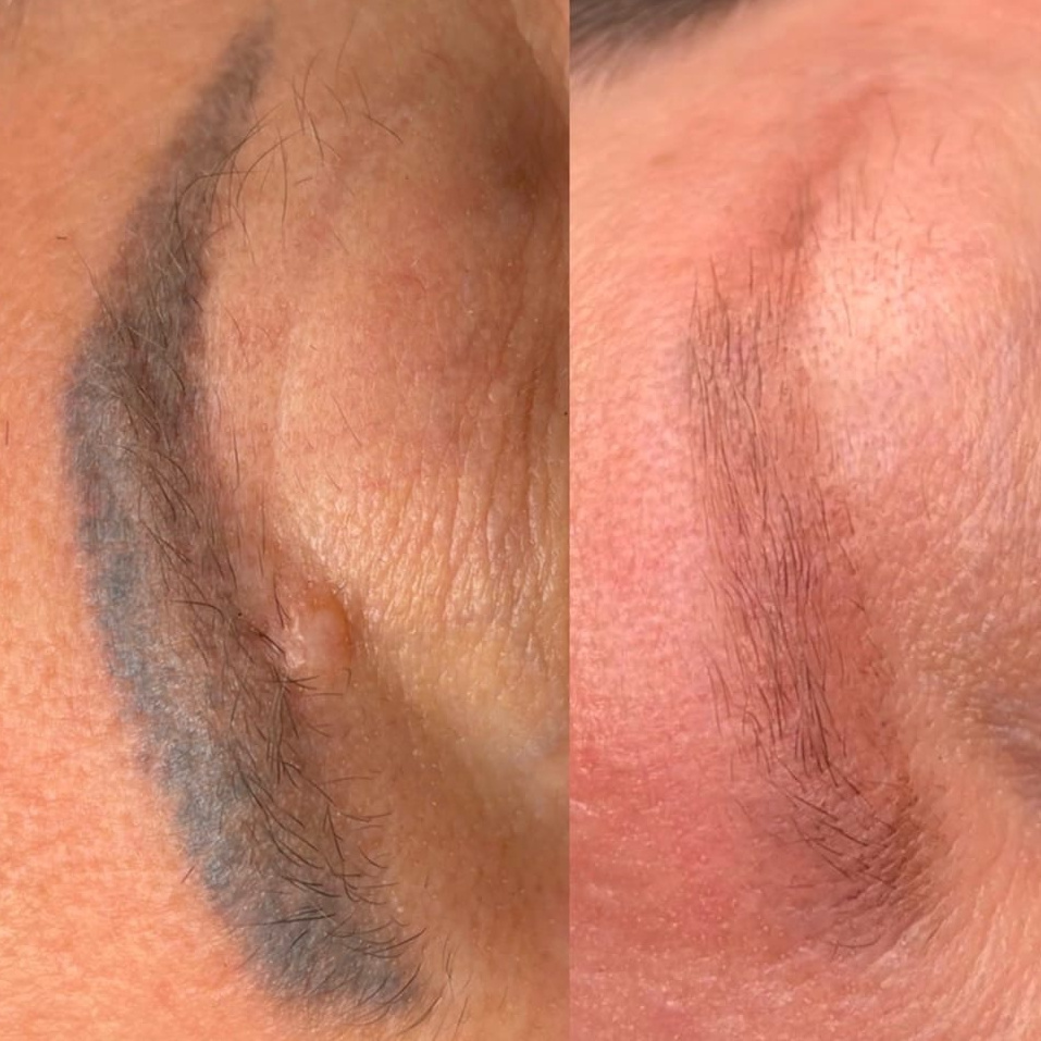 Удаление перманентного макияжа лазером брови/губы