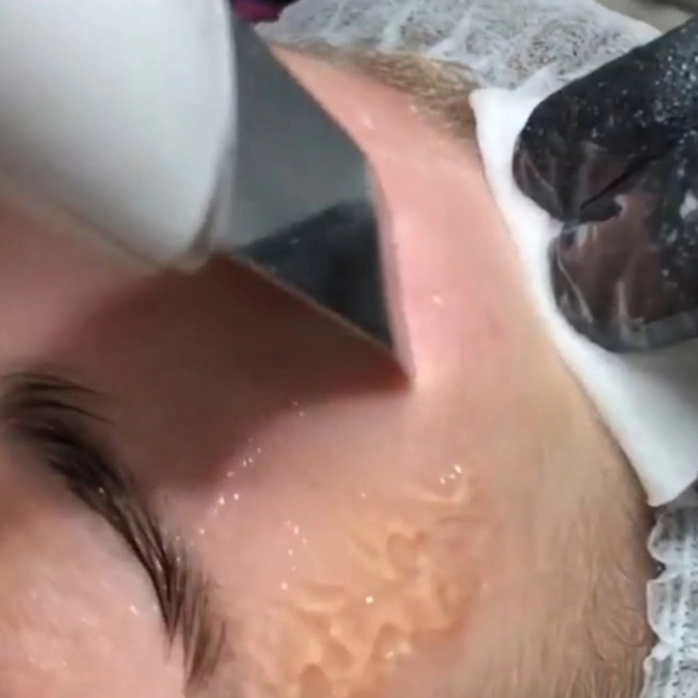 Комбинированная чистка лица