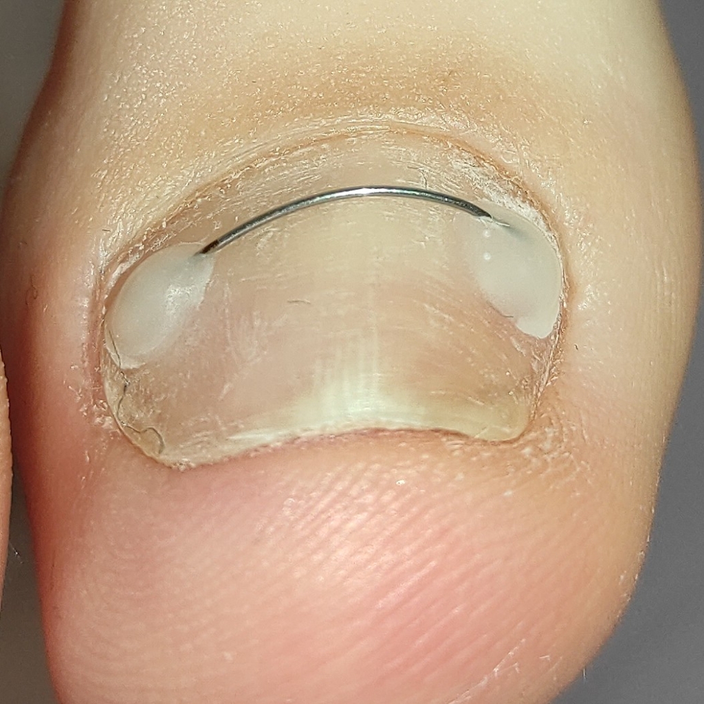 Установка титановой нити 1 большой ноготь