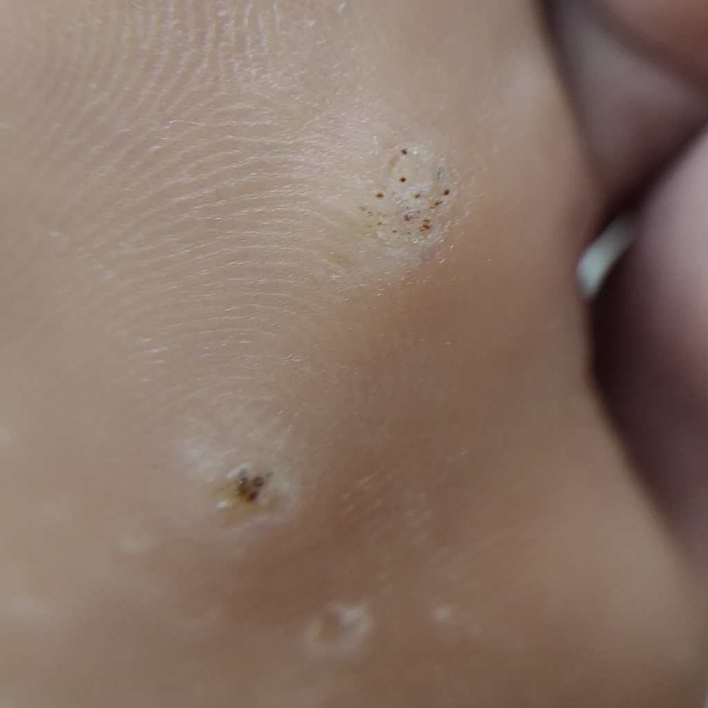 Обработка подошвенных бородавок более 10 штук