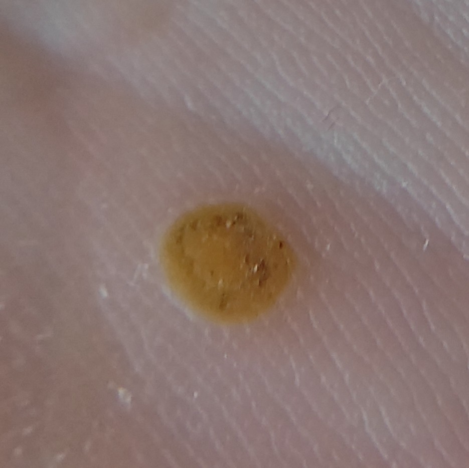 Обработка одной ладонной бородавки