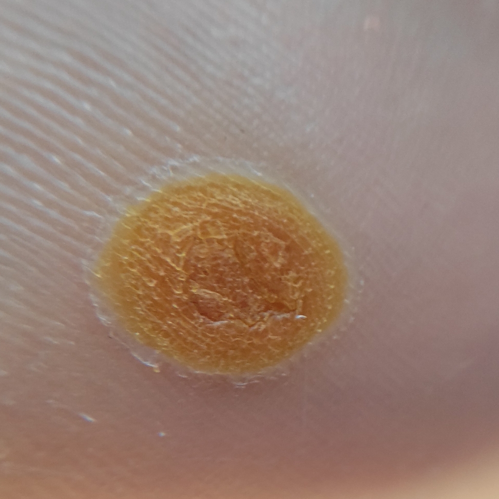 Обработка подошвенных бородавок от 1 до 3 штук