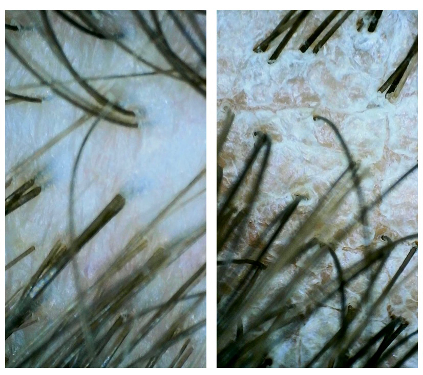 Пилинг кожи головы