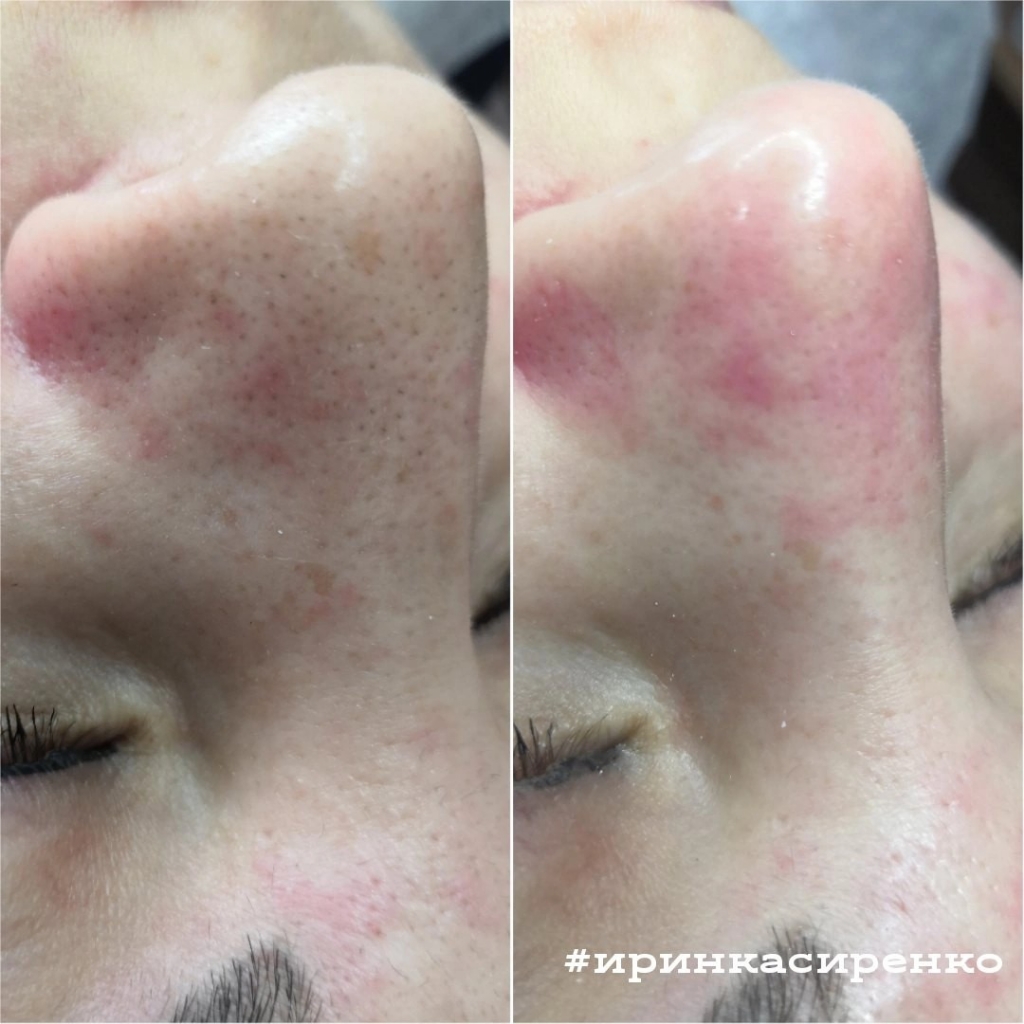 Чистка HYDRAFACIAL (вакуумный гидропилинг)