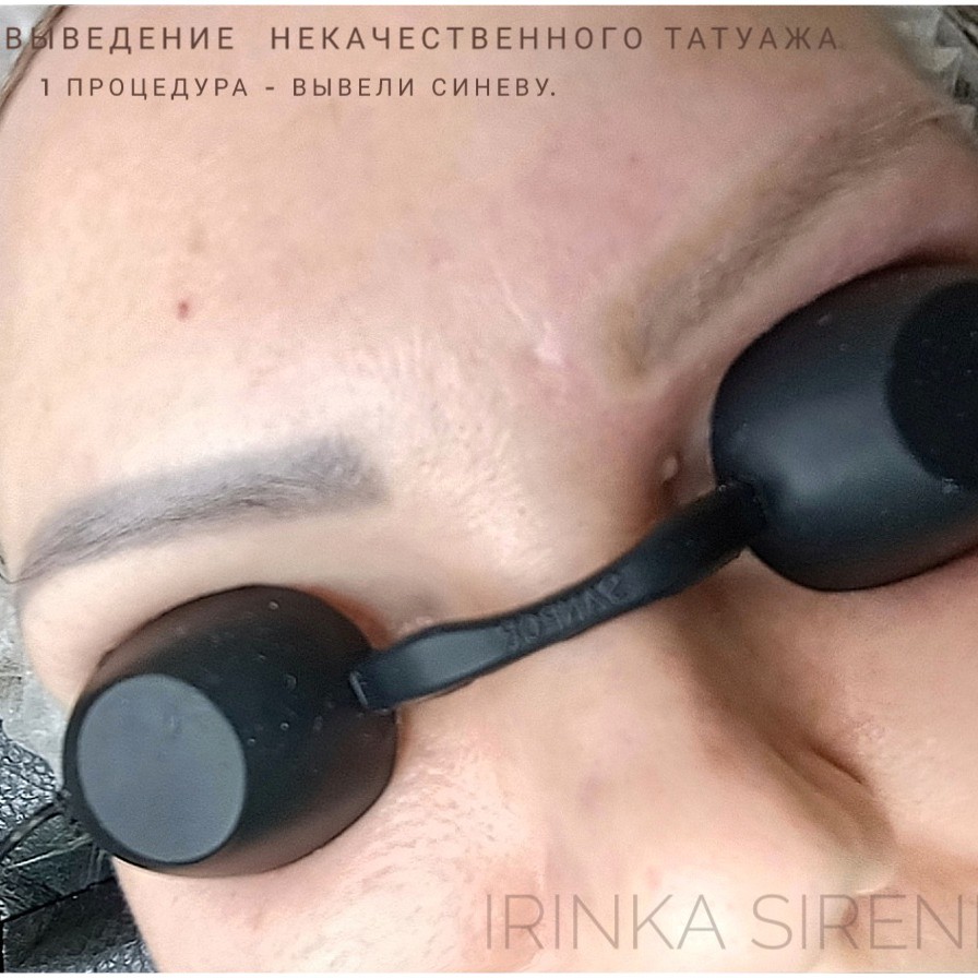 Удаление некачественного татуажа и тату