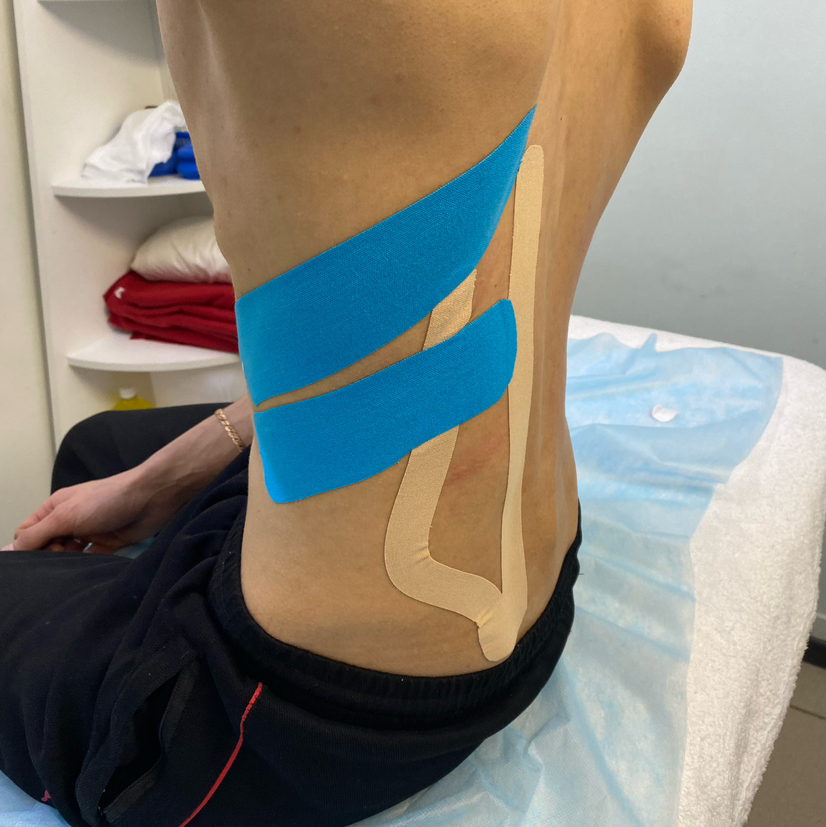 Тейпирование