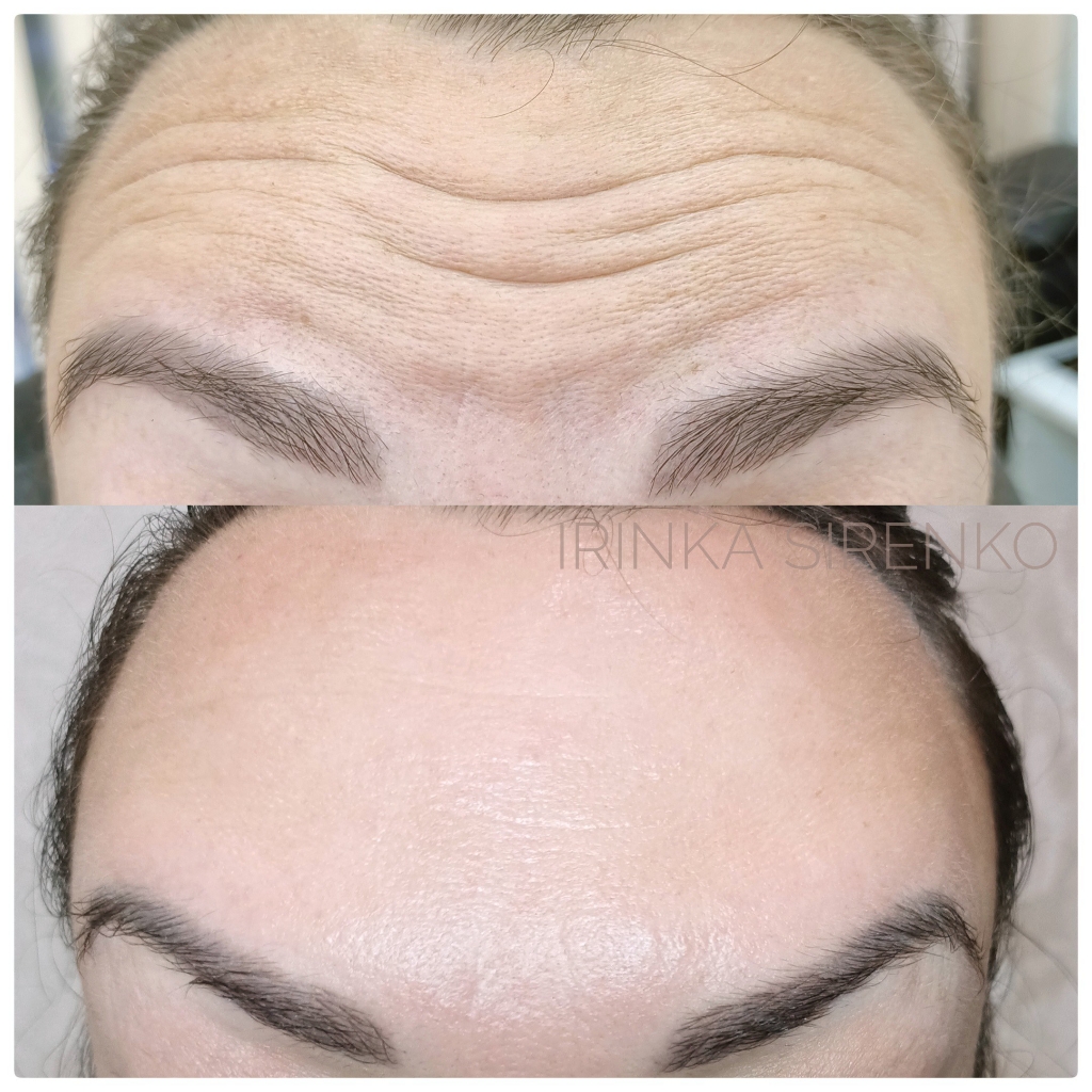 Ботулинотерапия(BOTOX)