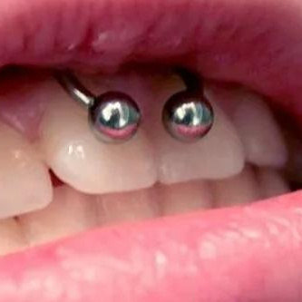 Пирсинг Смайл (на внутренней стороне верхней губы) 18+ Без стоимости украшения.