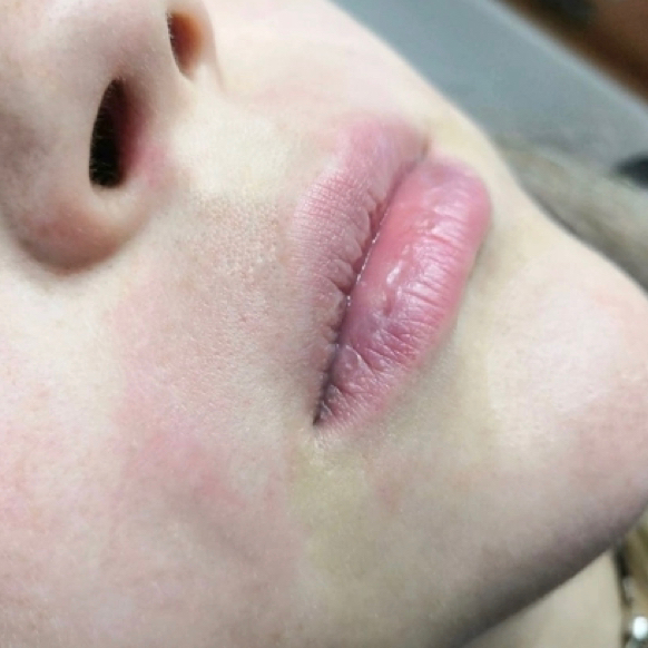 Депиляция одной зоны лица