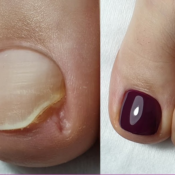 Ремонт травмированных ногтей на ногах