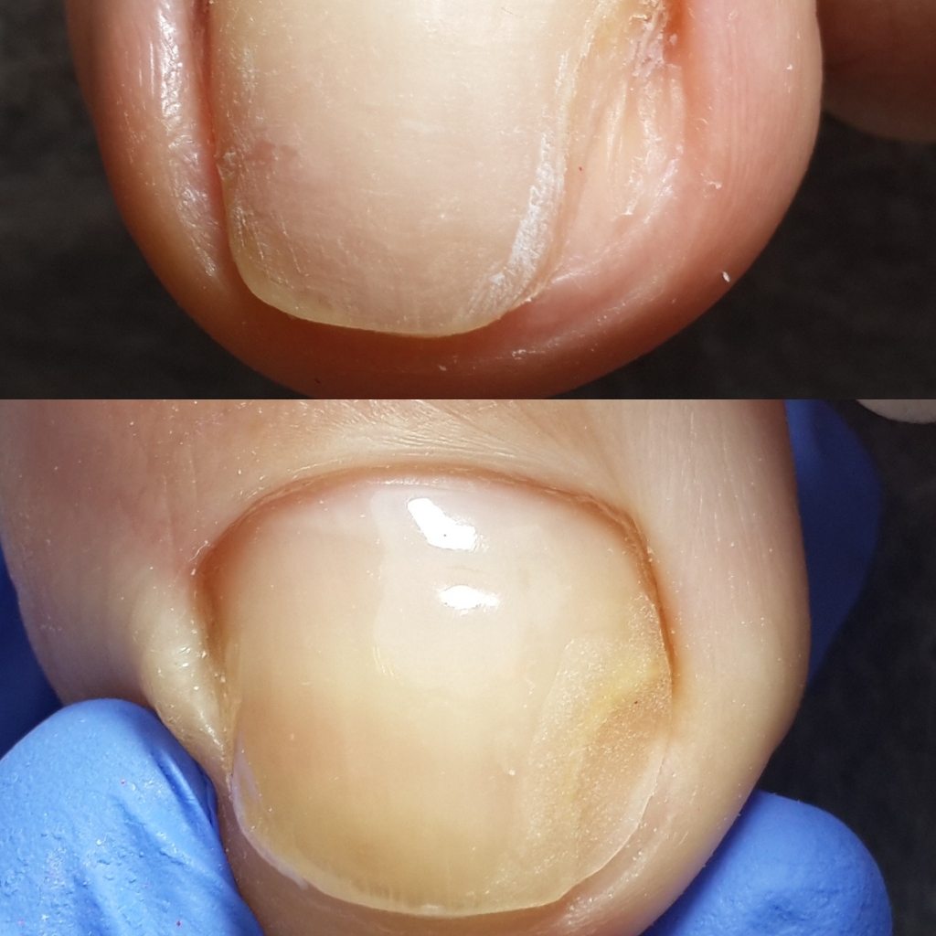 Протезирование ногтевой пластины на ногах (утрачено менее 30%) 1 ноготь