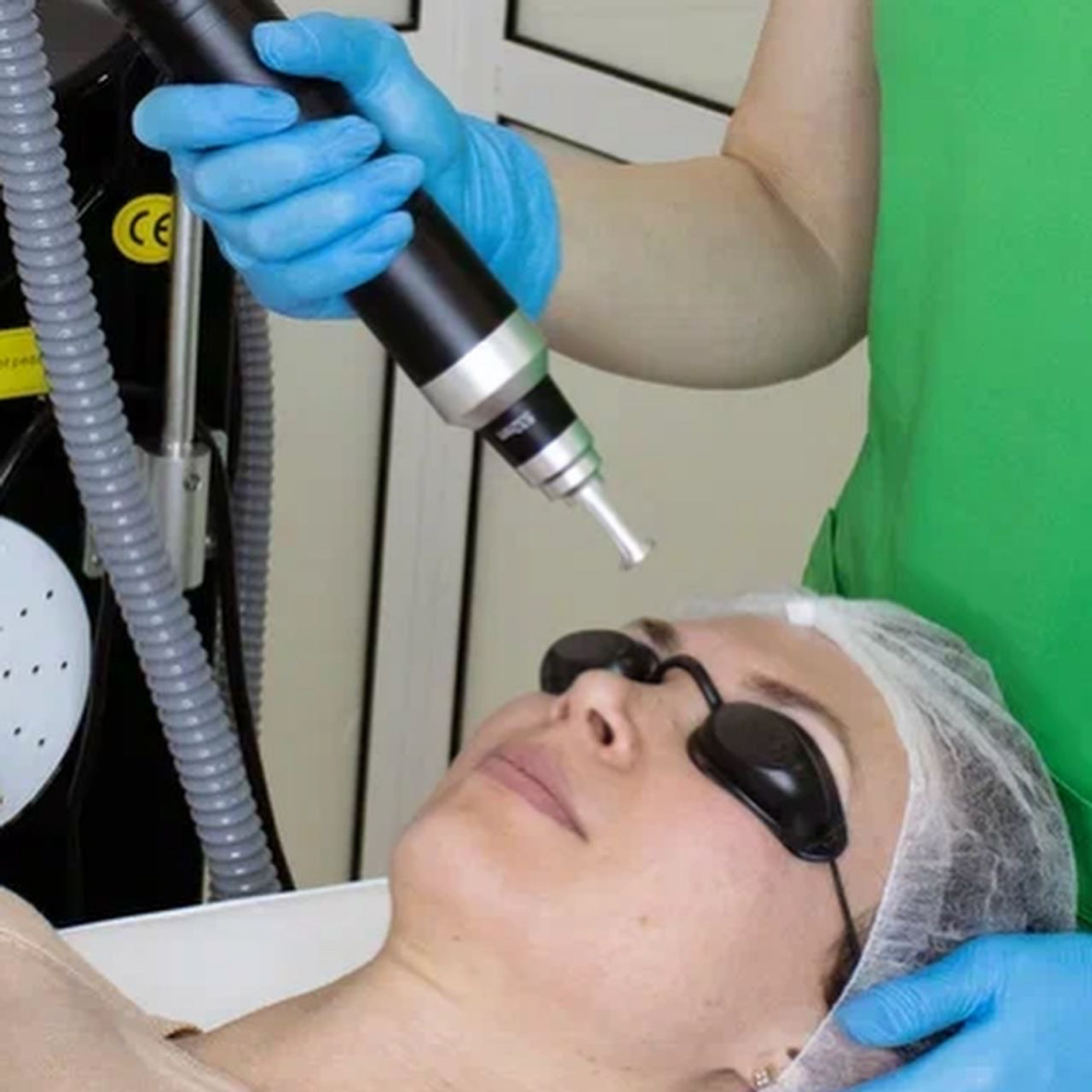 Удаление локальных пигментных пятен, пигментации на пикосекундном лазере