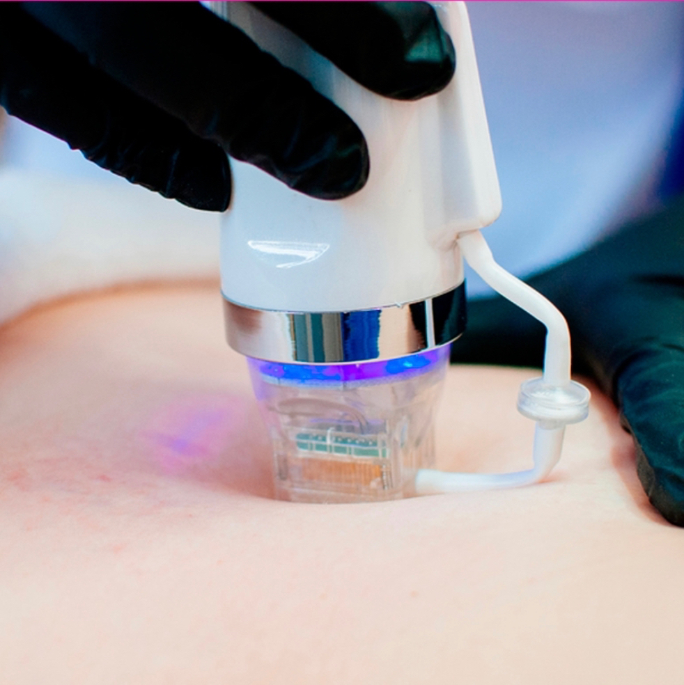 Микроигольчатый Rf-лифтинг лица