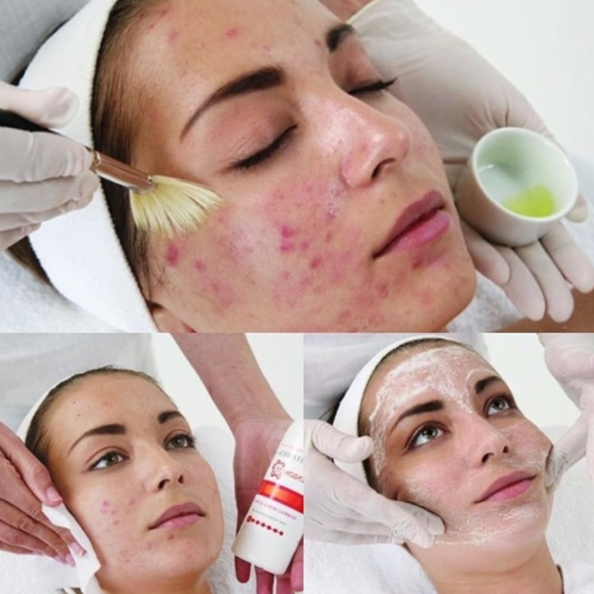 Анти -акне уход , устранение высыпаний , лечение воспаления