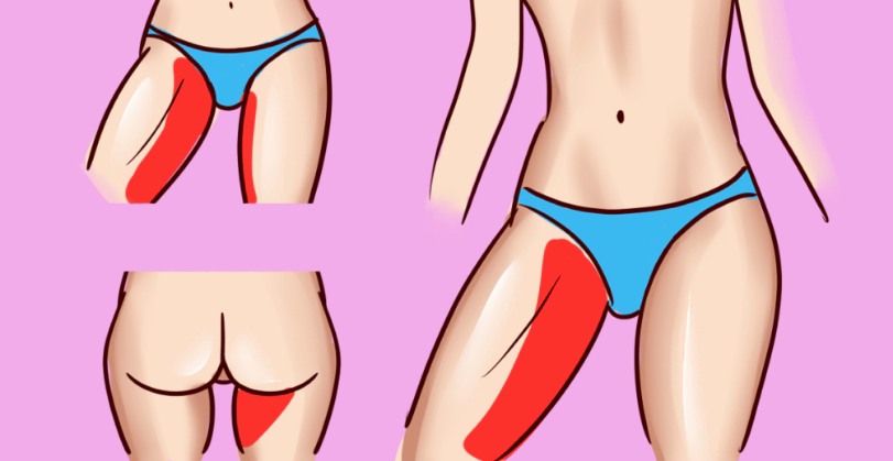 Rf-игольчатый бедро Внутр.ст.