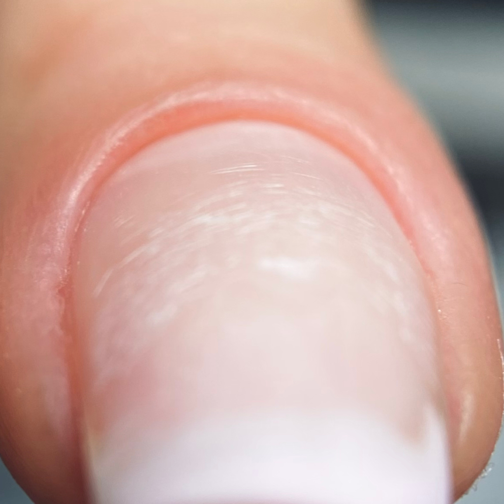 Снятие ногтей