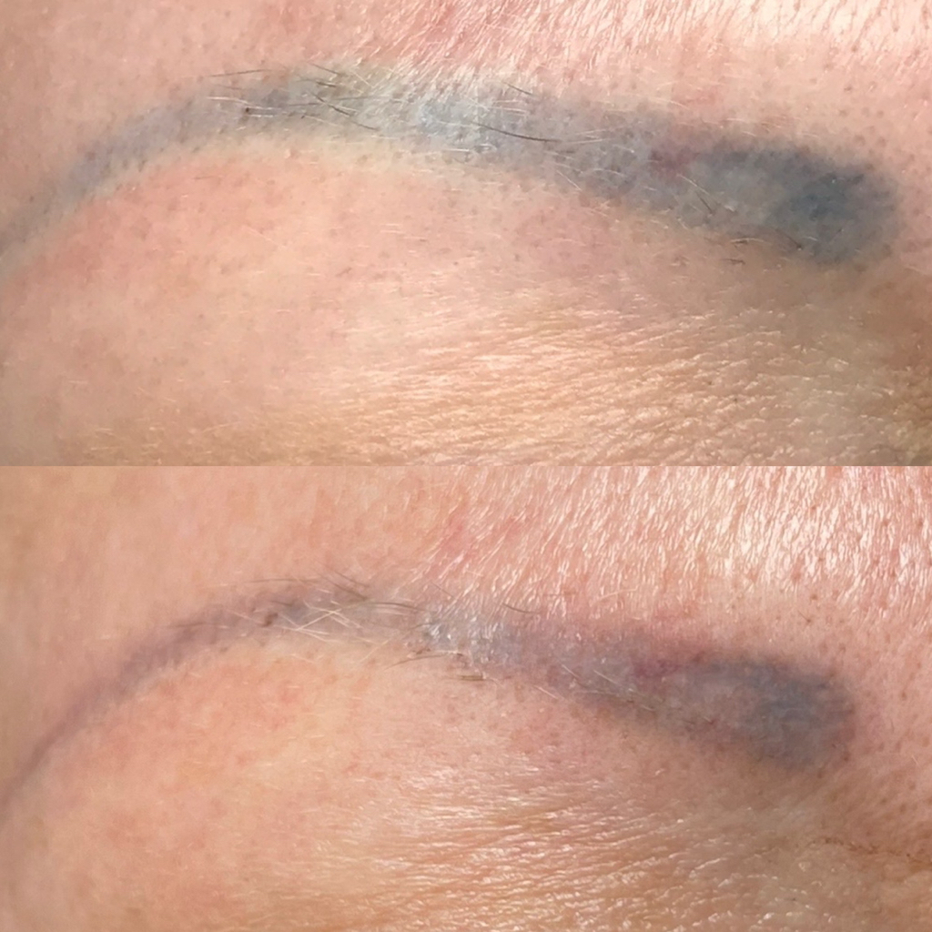 Удаление ПМ ремувером