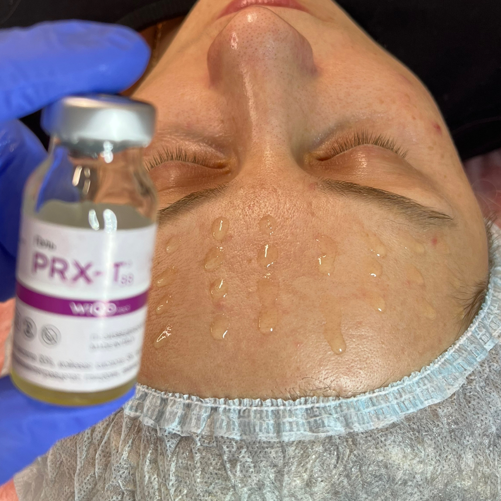 PRX-T33® Италия (омолаживающий пилинг)