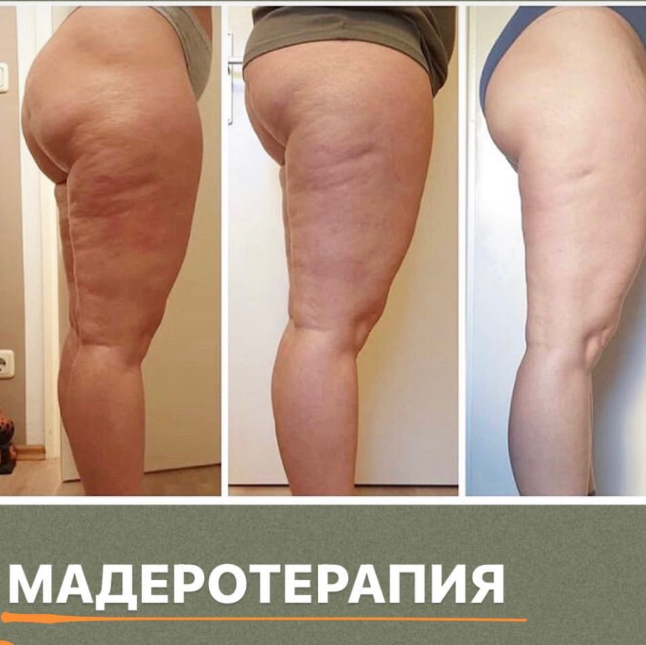 Мадеротерапия всего тела