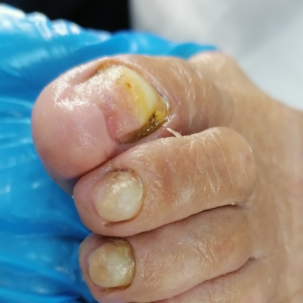 Обработка ногтей с грибковым поражением