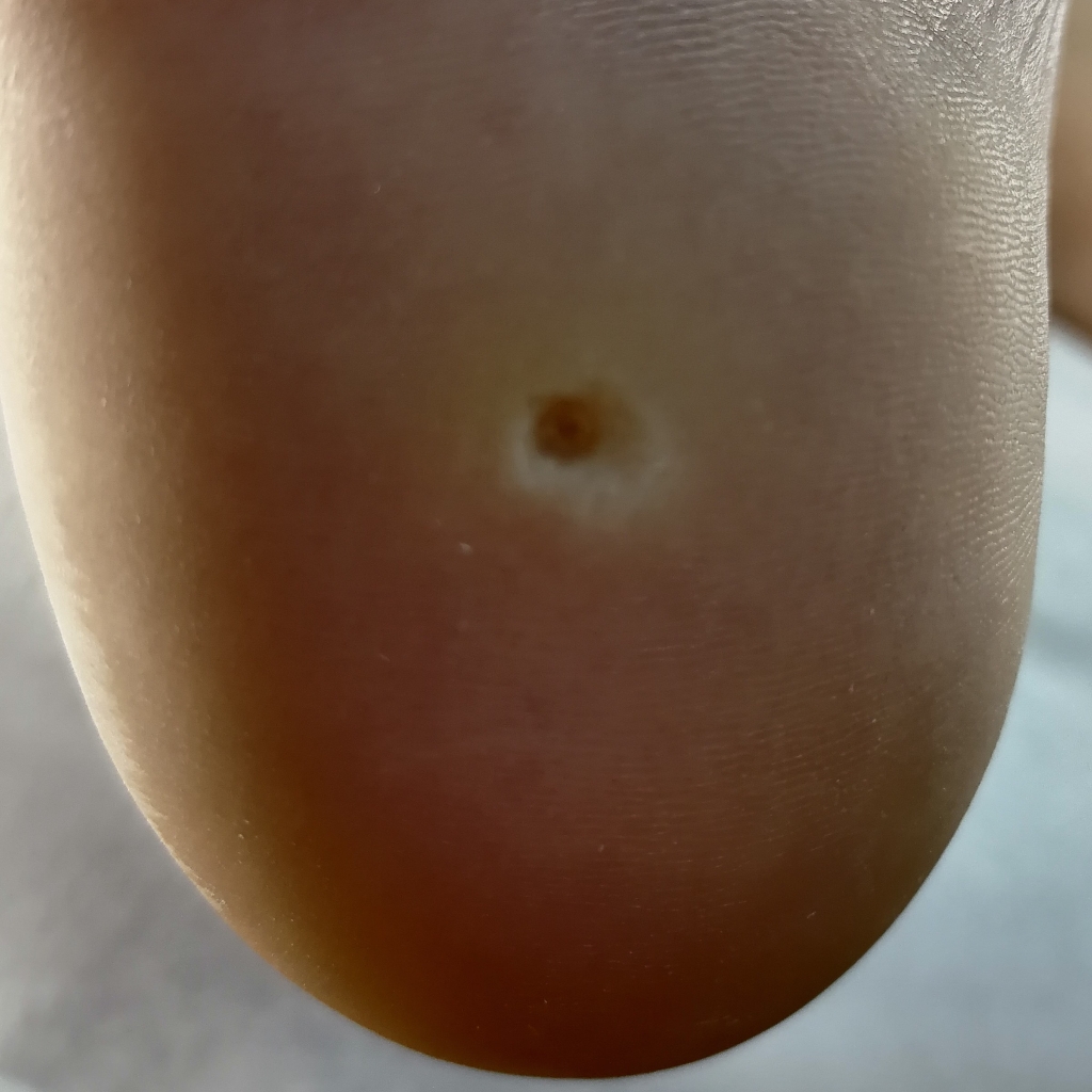 Обработка стержневой мозоли