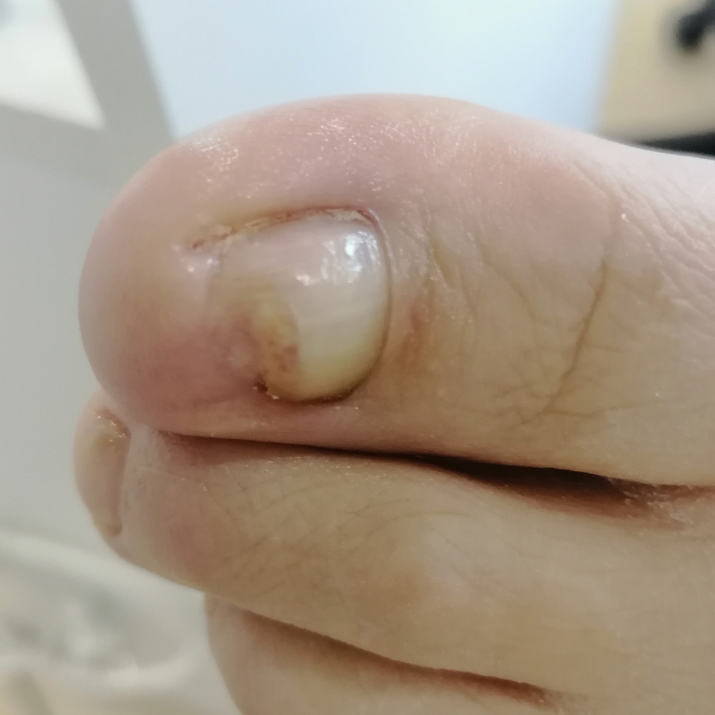 Обработка онихолизиса