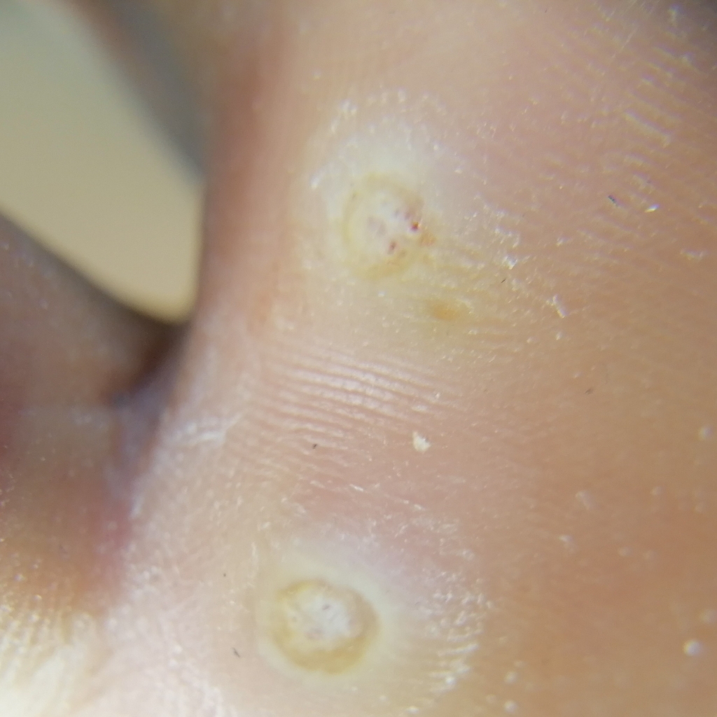 Обработка подошвенной бородавки