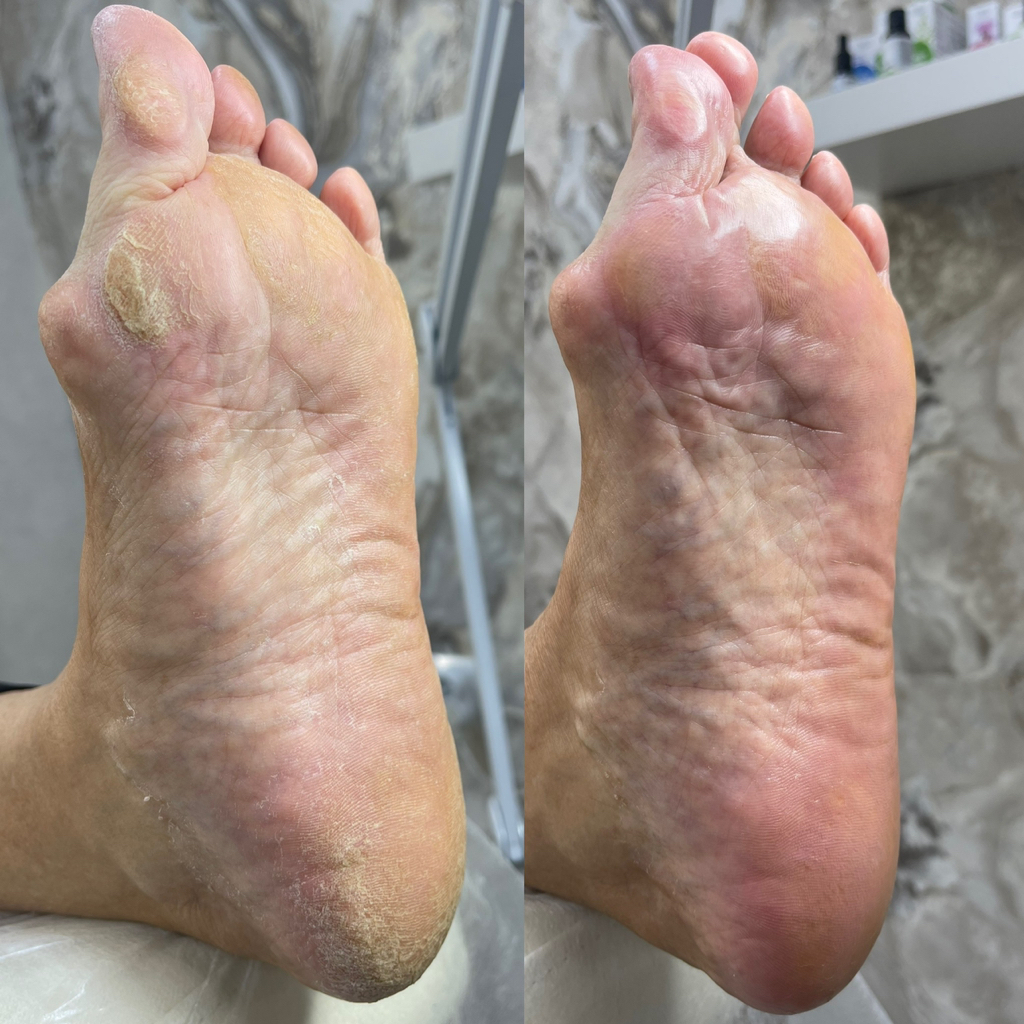 Аппаратный педикюр