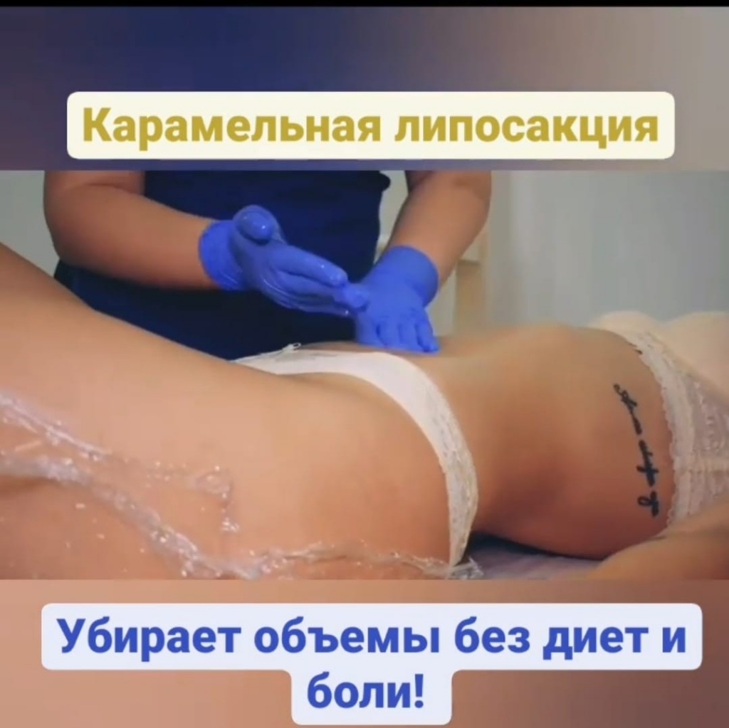 Карамельная липосакция ноги, бедра, ягодицы