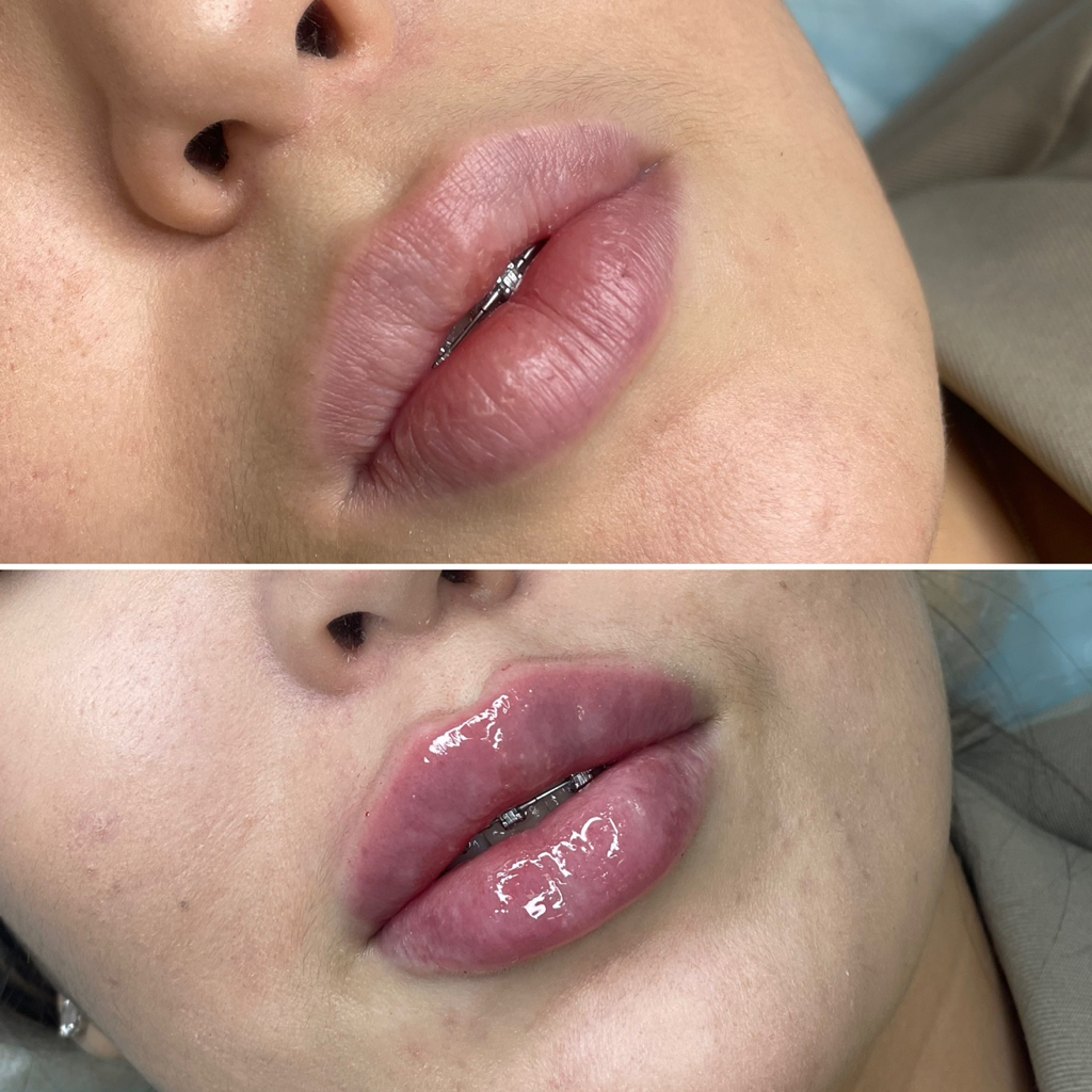 Контурная пластика губ