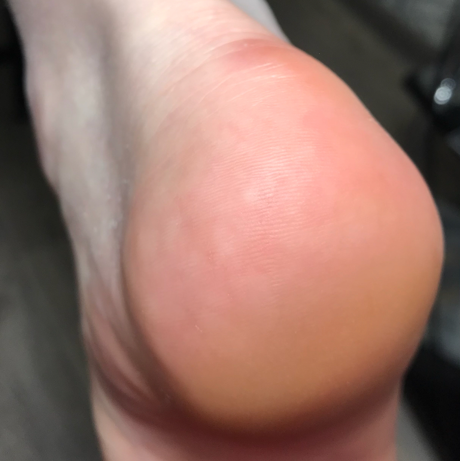 Аппаратный педикюр