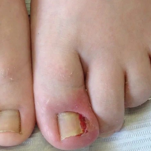 Обработка проблемного ногтя