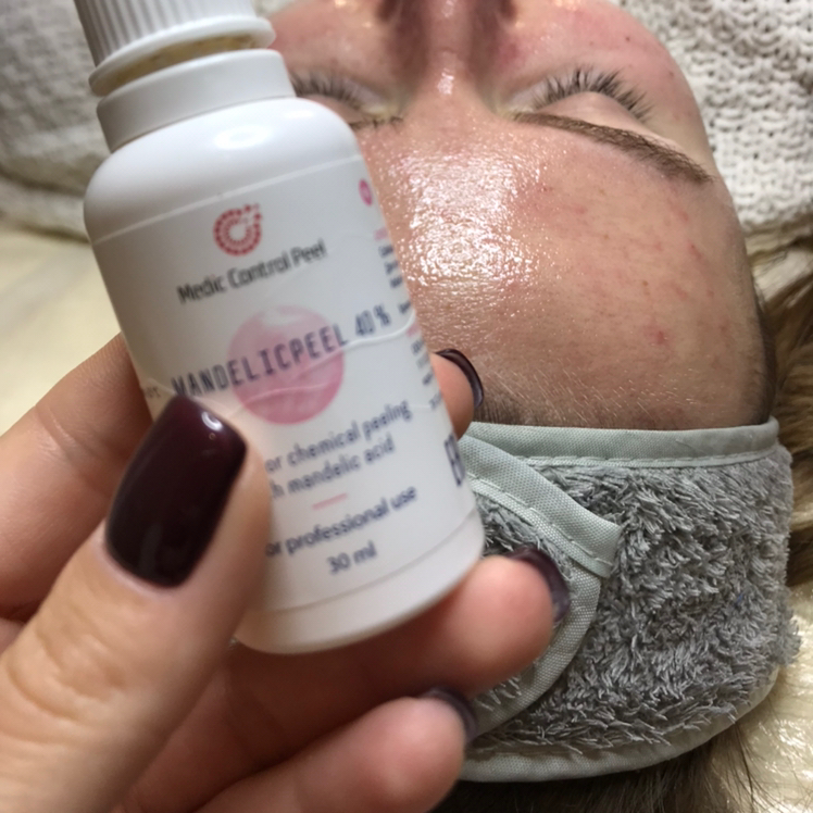 Чистка лица + поверхностный химический пилинг